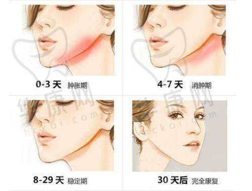 选择广州做人中整形骨干医生要注意什么？