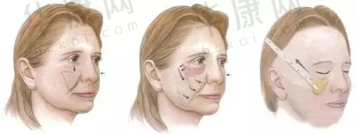 如何选择适合自己的广州整形美容医院？