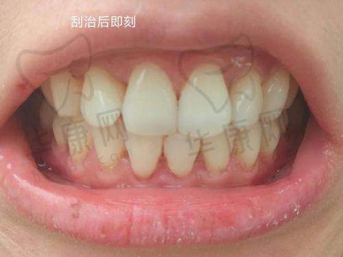 厦门登特口腔医院龈下刮治的服务优势