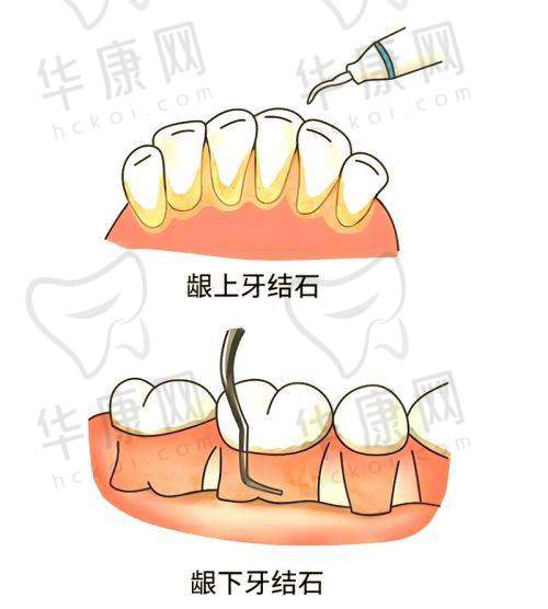 厦门登特口腔医院龈下刮治的技术优势