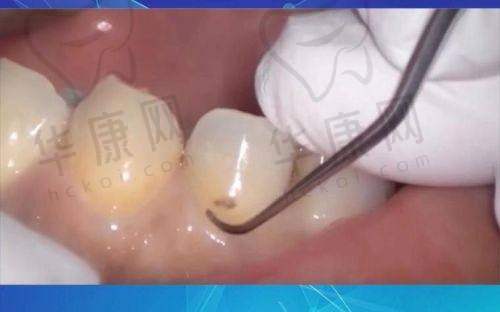 厦门登特口腔医院龈下刮治399元起，专业技术开启口腔深度清洁新体验
