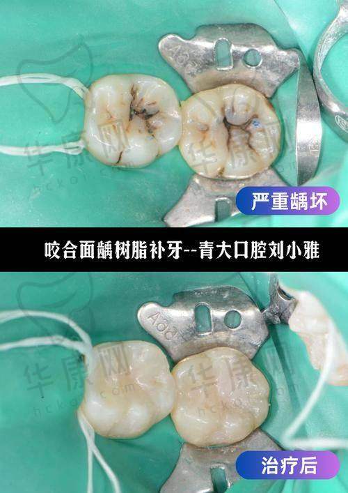 泰安牙博士口腔美塑树脂补牙的材料优势