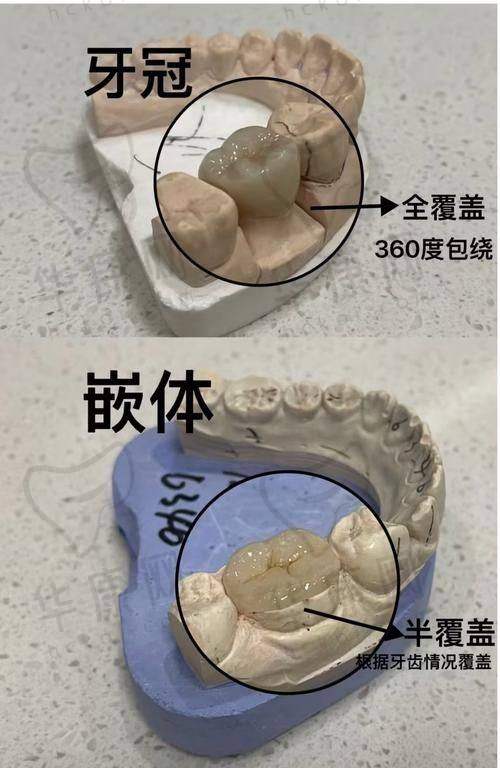 嵌体修复后的显著成效