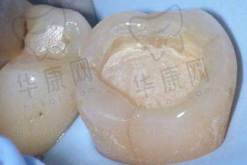 专精医生的嵌体修复诊断