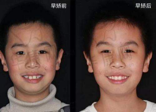 丽江九洲医院口腔科儿童隐形矫正的后续服务