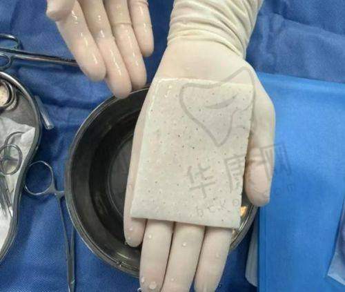 光子嫩肤的实际成效怎样?有实例吗?