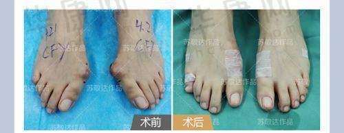 深圳悦尔医疗美容卜君璘烧烫伤疤痕修复的预约方式