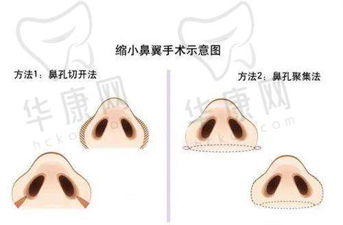 袁强博士拉皮手术技术如何？
