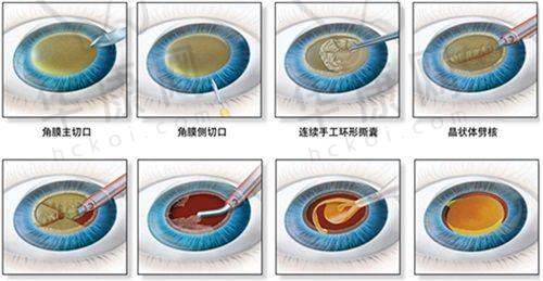 合肥普瑞眼科医院挂号预约流程全公开，多种方式+注意事项助您一键快捷挂号