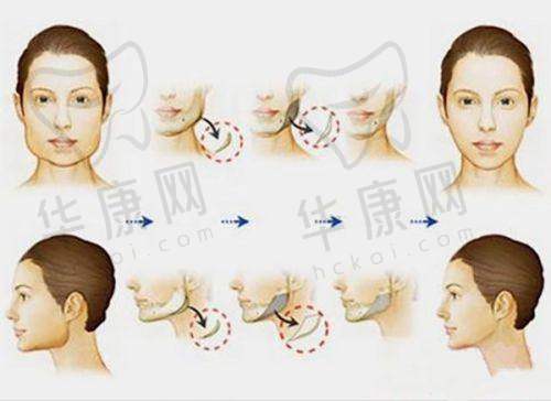 广州广大医院何锦泉医生做正颌手术实力怎样？