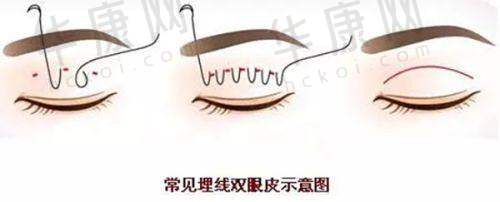 驼峰鼻矫正手术可能带来的影响