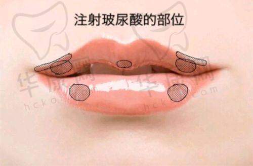 任晓丽医生在面部美学玻尿酸注射塑形上的优势