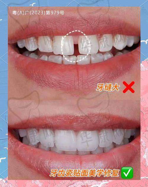 沈阳九诺口腔医生在爱尔创全瓷冠项目上的专精能力