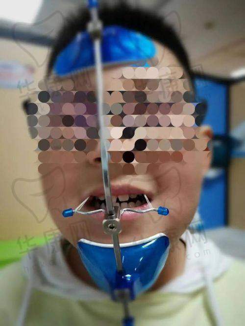 济南弗莱堡口腔儿童早期矫正的技术优势