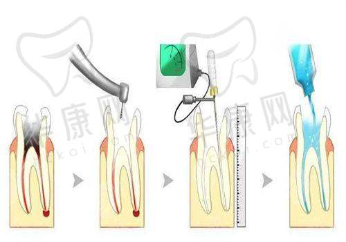 榆林兔博士口腔儿童乳后牙根管治疗的技术优势