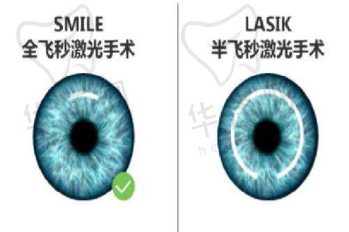北京茗视光眼科医院全飞秒手术的优势体现在哪？