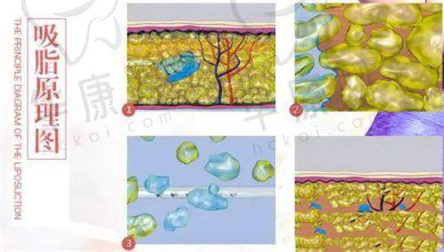 成都高新米兰柏羽医学美容医院在形体吸脂方面的特色优势