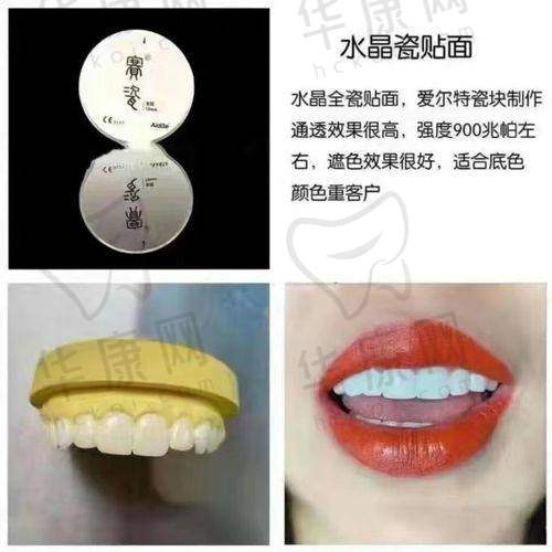 重庆美奥口腔超薄美学全瓷贴面的适用人群