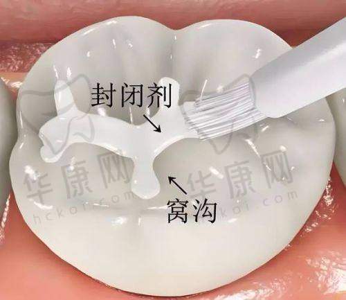 上海维乐口腔医生在儿童窝沟封闭项目的专精优势