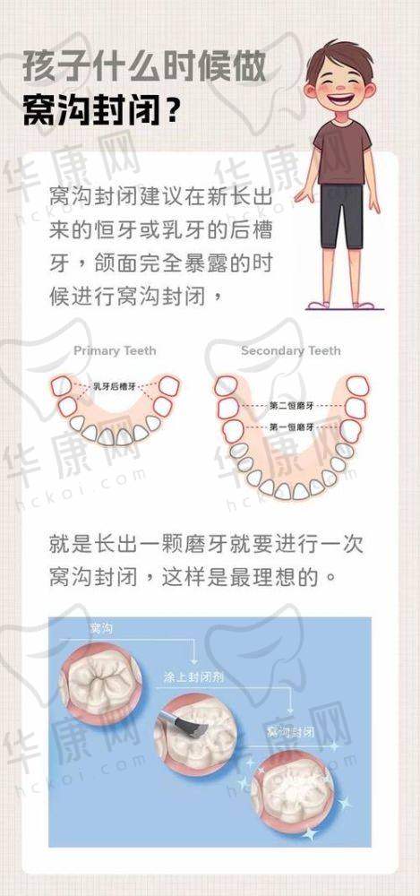 儿童窝沟封闭的重要性