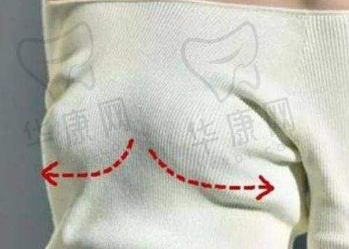 昆明梦想医疗美容医院洪晓娅复合隆鼻的成功实例与口碑