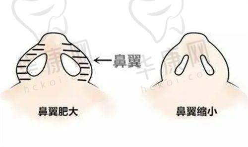腹壁成形手术当天的体验