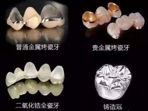 鞍山德立联合口腔爱尔创全瓷冠医生优势