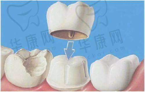 北海柏乐口腔威兰德全瓷冠的质量保护优势