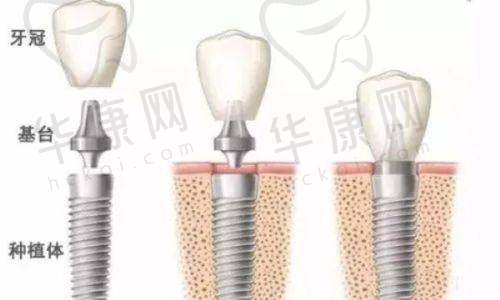 重庆南岸名博士口腔周林韩国登腾种植牙2980元起，高性价比之选！