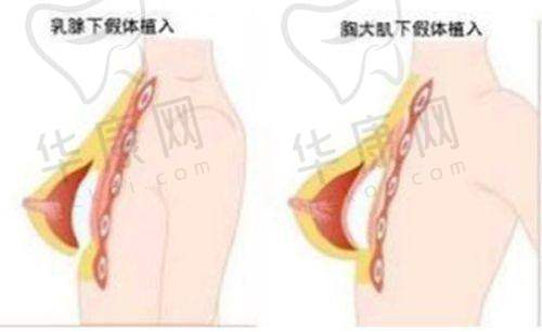 总结无锡坤如玛丽整形医院张凡双眼皮的优势