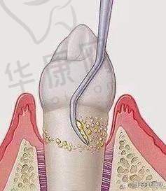 昆山牙博士口腔半口龈下刮治的医生特色