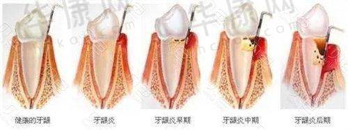 昆山牙博士口腔半口龈下刮治1614元起，专业技术高效去除牙结石！