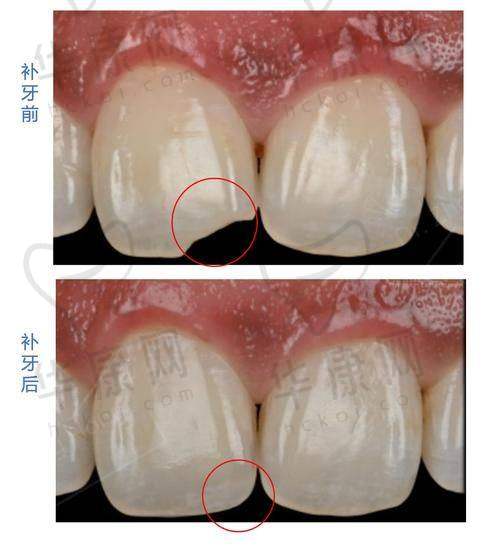 昆山牙博士口腔美国3MP60树脂补牙与其他医院对比优势