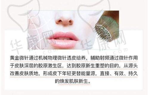 什么是广州韩妃的风筝小拉皮手术提升下颌缘？