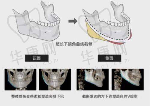 无锡坤如玛丽整形医院在丰胸项目上的特色优势