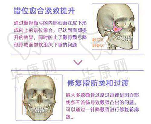 李在郁医生的“三维动态注射体系”核心优势是什么？详细解读