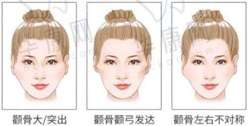 洛阳莱尔美整形医院刘战辉双侧耳软骨隆鼻的手术成效