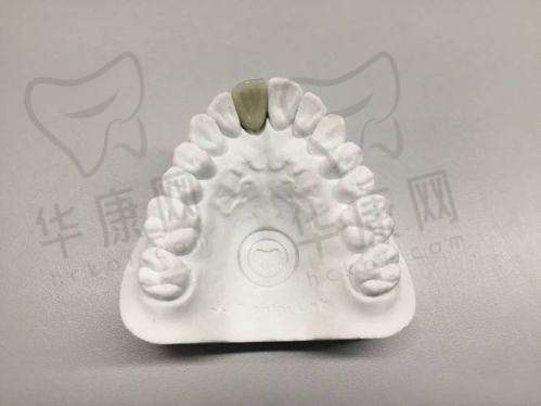 海南国雅口腔医院钴铬合金烤瓷牙的美观设计