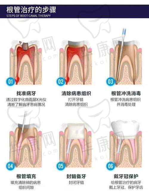 慈溪博瓦口腔后牙根管治疗仅880元起，口碑好技术稳治疗超放心