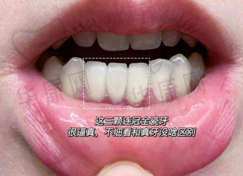 慈溪博瓦口腔全瓷冠项目的综合优势