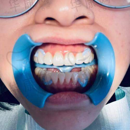 冷光美白后的成效