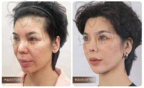 成都高新米兰柏羽医学美容医院黄文医生特色技术优势