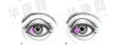杭州黑马眼科近视手术怕疼？全飞秒体验后毫无痛感，摘镜惊喜似开盲盒！