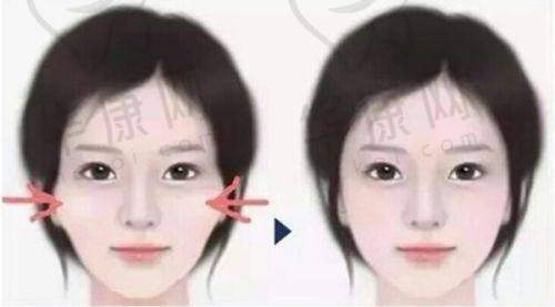 鼻综合术后40天修复情况