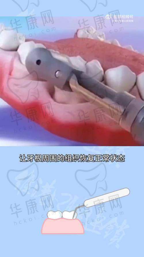 惠州粤口口腔轻度牙周刮治的服务优势