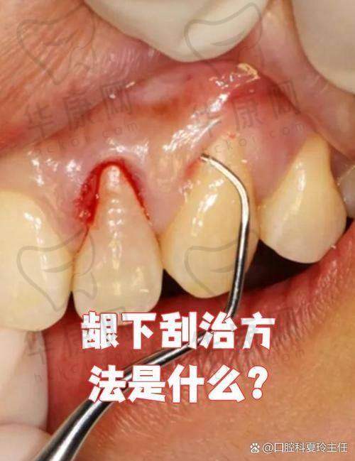 南通海门嘉仁口腔全口龈下刮治1980元起，正规连锁品质服务超划算
