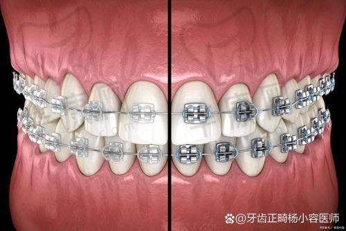 西藏拉萨雅博仕口腔医院在隐适美隐形矫正方面的特色优势
