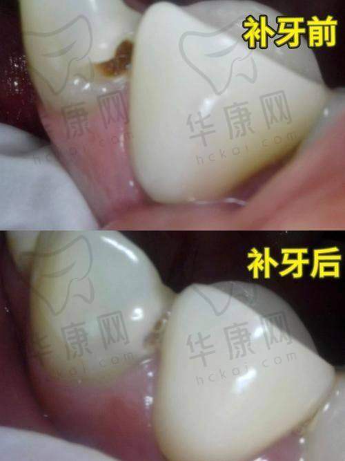 南通海门嘉仁口腔义获嘉美学树脂补牙464元起，高端修复性价比之选