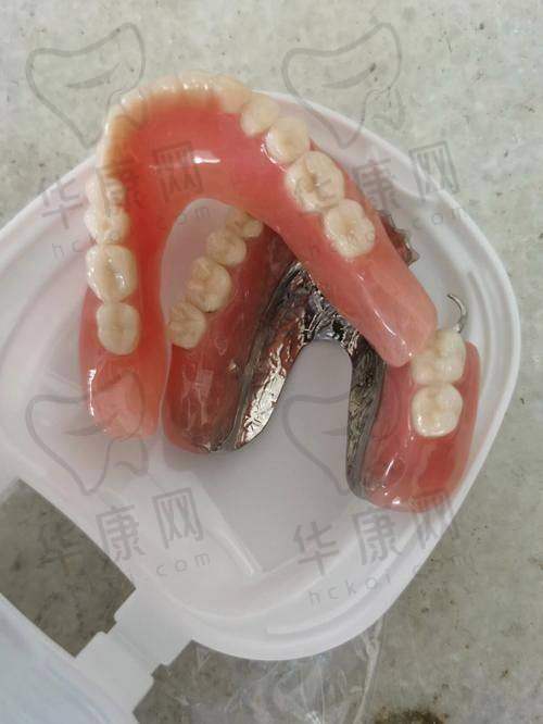 惠州粤口口腔半口活动义齿的医院优势