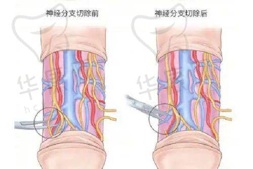 周国伟医生在半肋软骨隆鼻上的技术特色
